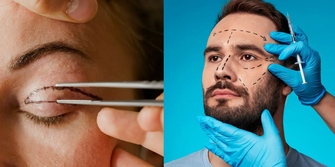 Blepharoplasty