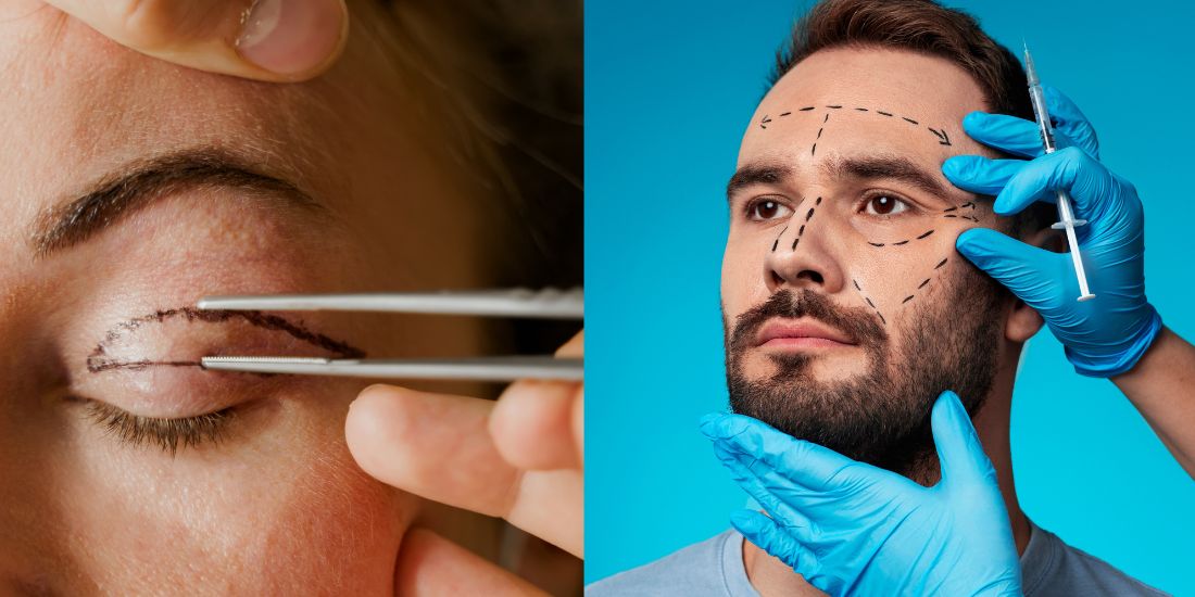 Blepharoplasty